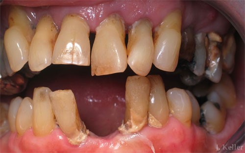 Partial Dentures For Back 
      Teeth New York NY 10045